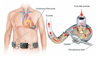 Ventricular Assist Devices Market