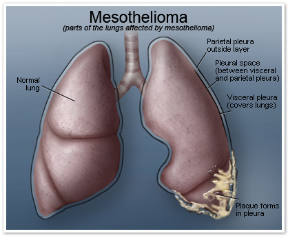 asbestos and types of cancer