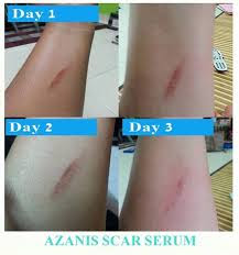 Testimoni azanis scar serum