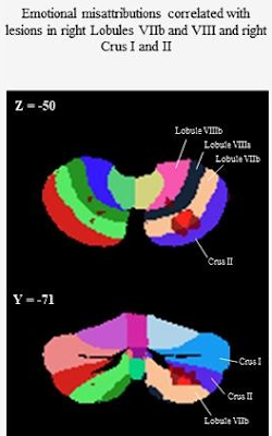 小脳後方部と情動認識