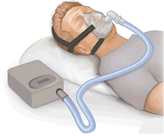 Middelen tegen snurken - CPAP-masker