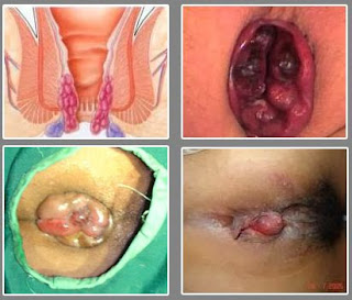 cara menghilangkan benjolan ambeien di lubang dubur