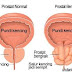Kanser Prostat.