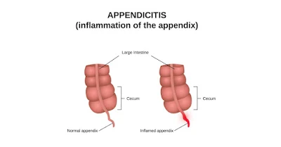 Appendicitis Disease: परिभाषा, प्रकार, कारण, लक्षण व रोकथाम के उपाय