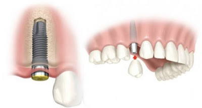 Nâng xoang hàm trong cấy ghép Implant là gì?