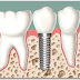 ĐIỀU TRỊ TUỶ RĂNG