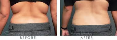 lipodissolve liposuction