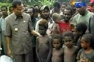 95 Anak Papua Mati Karena Busung Lapar