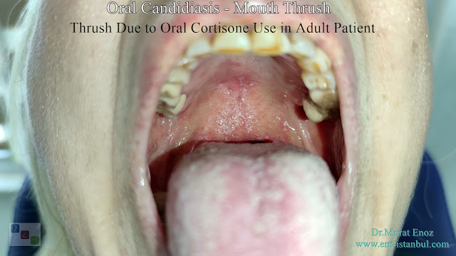 Oral candidiasis, Mouth thrush, Candida infection of soft palate,Oral thrush, Yeast infection in mouth