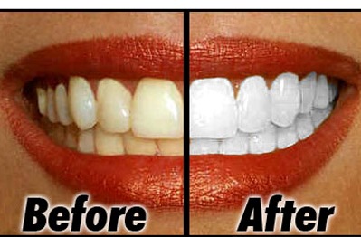 11 Cara Memutihkan Gigi Secara Alami