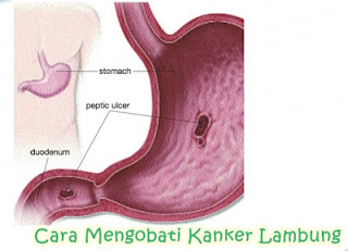 Cara Mengobati Kanker Lambung