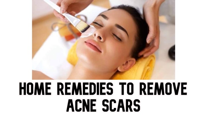 Home remedies to remove acne scars Fully! - metabloginfo