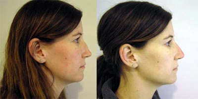 Nose Surgery  Before And After