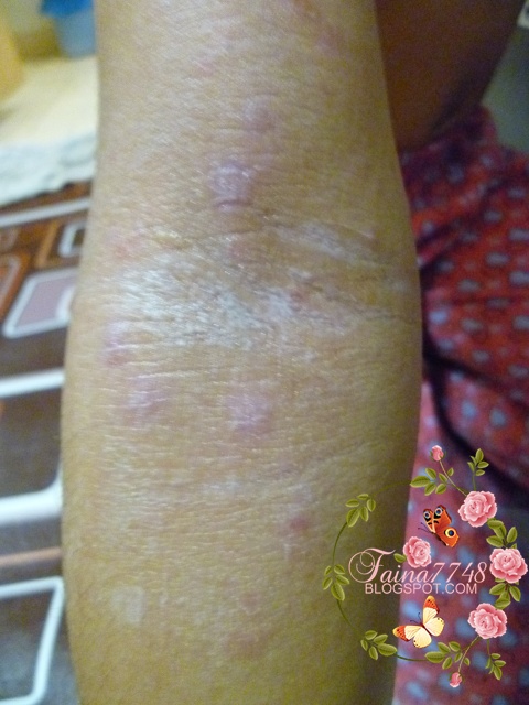 Lakaran Kehidupan Putra Putri Raudhah: Scabies aka Kudis 