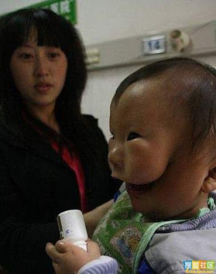 Baby With Double Face in China