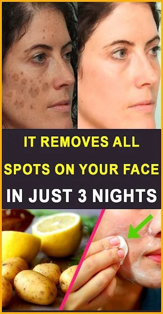 Home Remedies For Dark Spots
