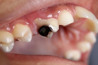 Giải pháp điều trị răng sâu ăn vào tủy