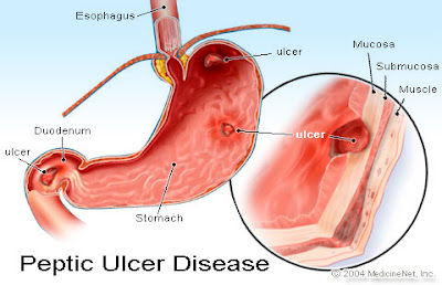 ulcer