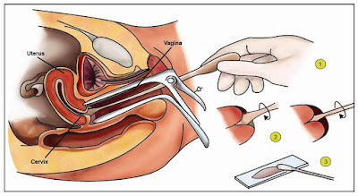 teknik-pap-smear