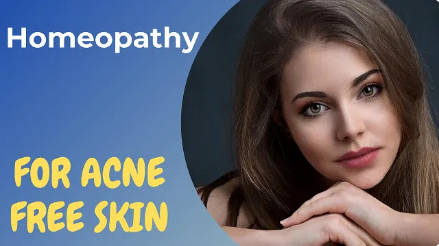 homeopathy for acne and pimples