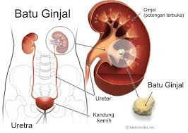 Obat Ampuh mengatasi penyakit batu ginjal dan memulihkan fungsi ginjal