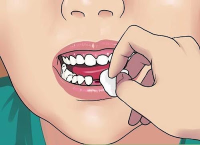 Nhổ răng trong trường hợp nào?