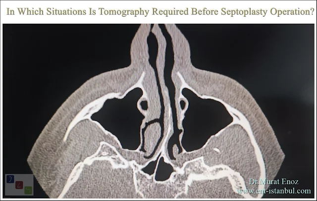 paranasal sinus tomograpy,Is a paranasal sinus tomography necessary before the septoplasty operation?,﻿Tomography indications before septoplasty