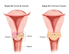 Causes of Cervical Cancer, Pathogenesis, Risk, Diagnosis