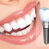 Trồng răng implant bao tiền?