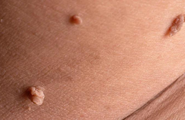 how to remove skin tags in one night