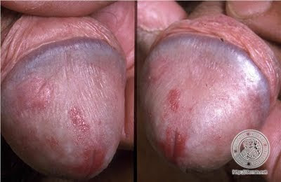 Obat Penyakit Sipilis Atau Raja Singa