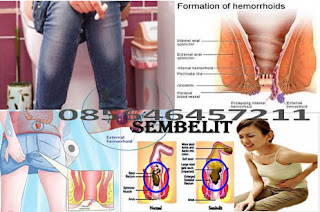 Nama Obat Buat Penyakit Wasir (Hemoroid)