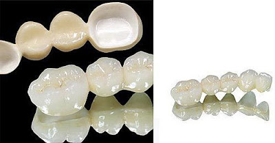 Ưu điểm của răng sứ thẩm mỹ không kim loại