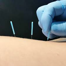 Dry Needling in Delhi & Gurgaon