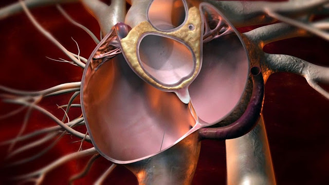 Patent Foramen Ovale (PFO) Closure Devices Market