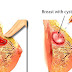 Breast cyst