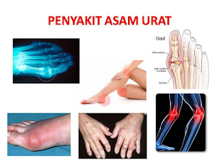 Akukepo | Penderita Kolesterol dan Asam Urat ! Inilah Obat Ampuh dan Alami Untuk Menyembuhkannya