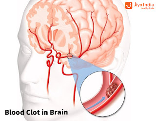  blood clot in brain surgery