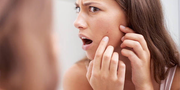 How to Get Rid of Redness from Pimples and Acne: A Guide to Calmer, Clearer Skin