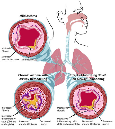 Natural Herbal Cure of Asthma