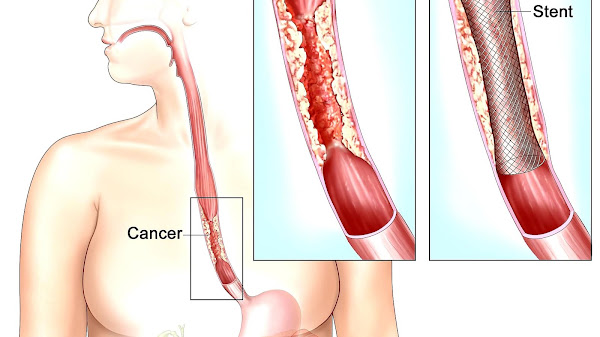 Stent Heart Recovery Time