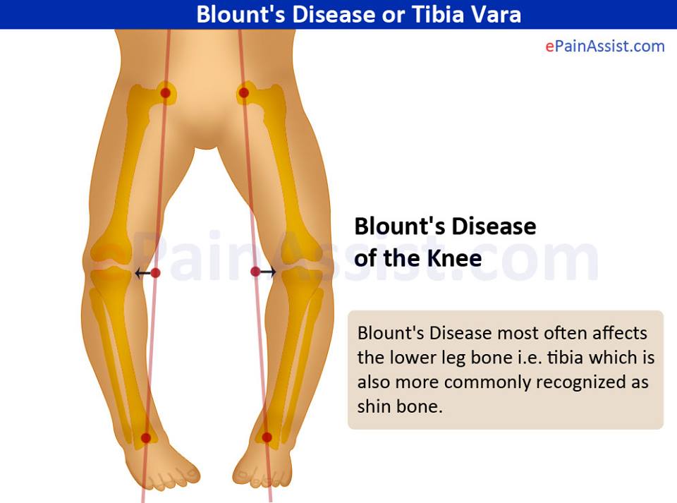 Tibia Vara (Blount Disease)