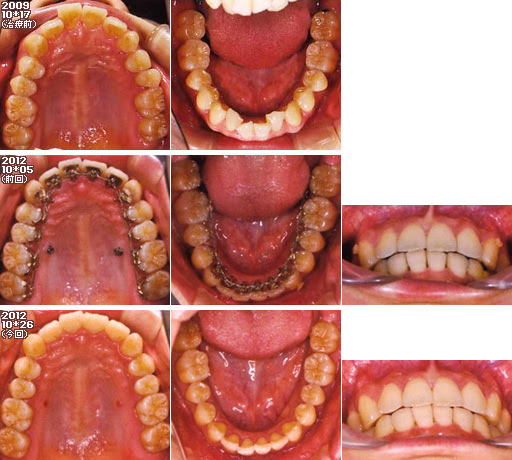 歯列矯正：定期検診その30