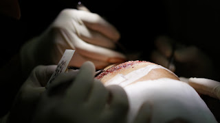 How is the FUE technique operated on patients