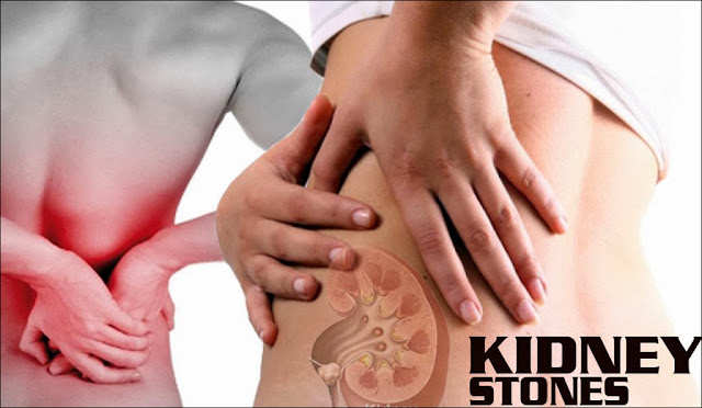 diet for kidney stones, diet for renal calculi, renal calculi diet, prevent kidney stones through diet