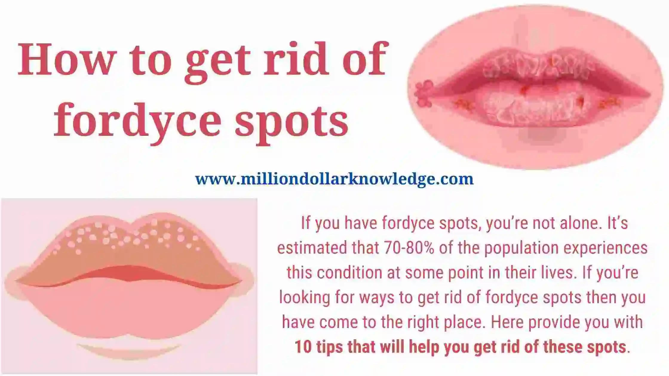 Million-$-Knowledge: How To Get Rid Of Fordyce Spots - 10 Best Remedies For Fordyce  Spots