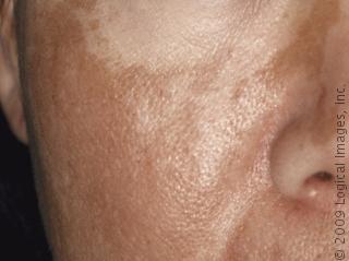 Natural Skin Bleaching: Melasma/Skin Discolorations