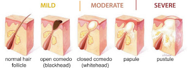 Hasil gambar untuk jenis jerawat