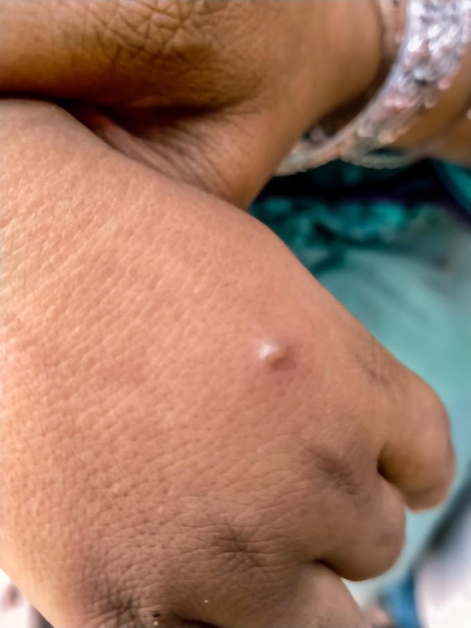 Por que o vírus Alaskapox agora atende pelo nome de Borealpox