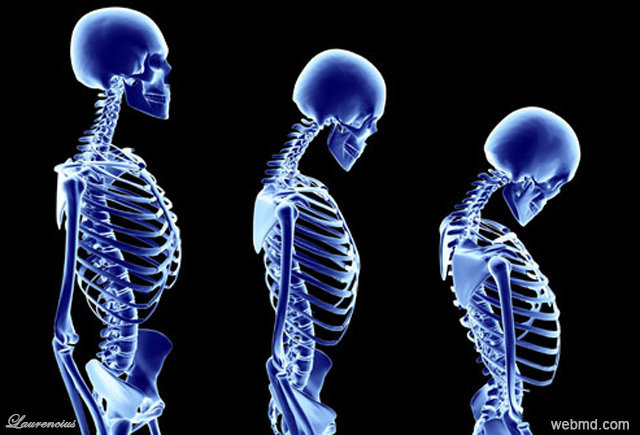  gambar  penyakit tulang  osteoporosis